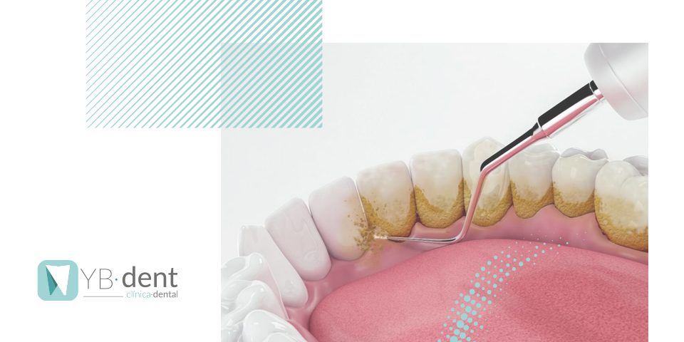 Qué es el cemento dental? YBdent Clínica dental Valencia